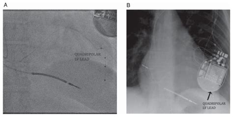 quartet left ventricular lead